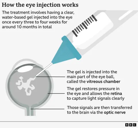 Revolutionary eye injection saved my sight, says first ever patient