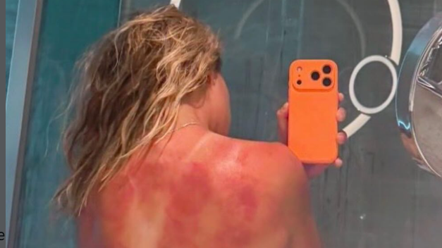 Renata Zarazua's sunburnt back
