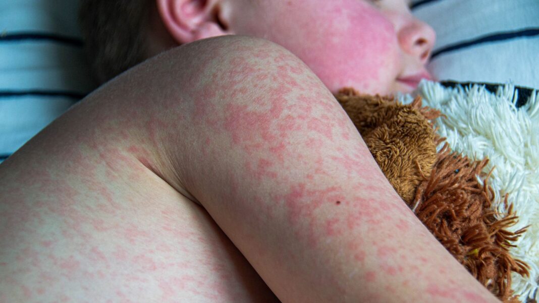 UK loses measles elimination status, warns WHO
