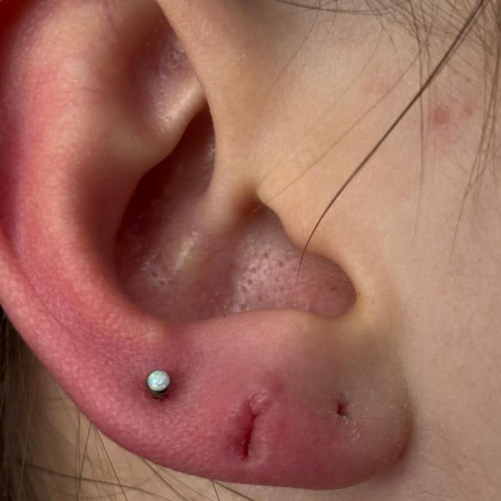 A close up imagine of a swollen infected ear piercing. There are three piercings on the lobe of the ear, with one stud earing in the third piercing.