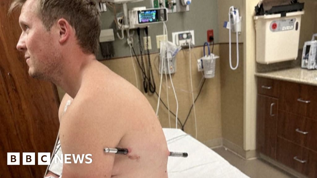 Man impaled by a hiking pole treks 10 miles down mountain Man impaled by a hiking pole treks 10 miles down mountain