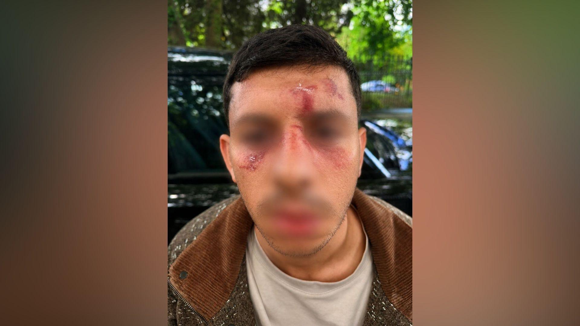Man with short dark hair. Face visibly injured. Partly blurred