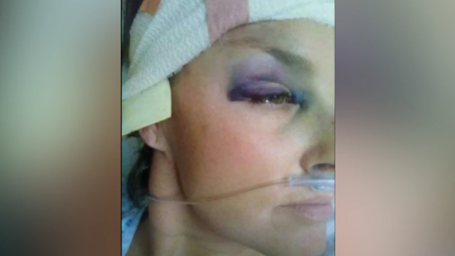 A close up selfie of Rachel with a swollen black eye. She is in hospital with a tube up her nose and a bandage around her head.