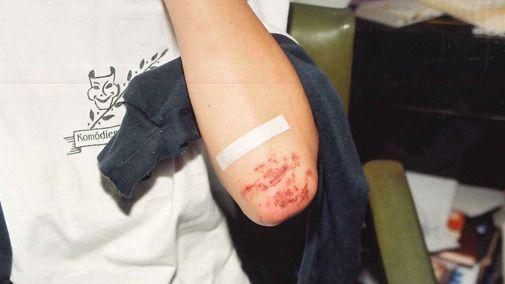 A close up of a woman's elbow with grazes and a plaster