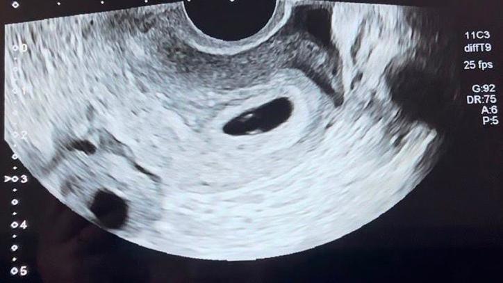 A baby scan picture