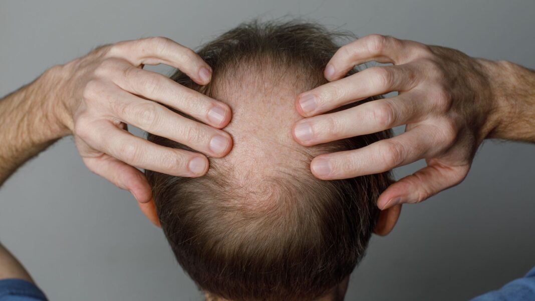 Weight loss drugs linked to increase risk of hair loss Weight loss drugs linked to increase risk of hair loss