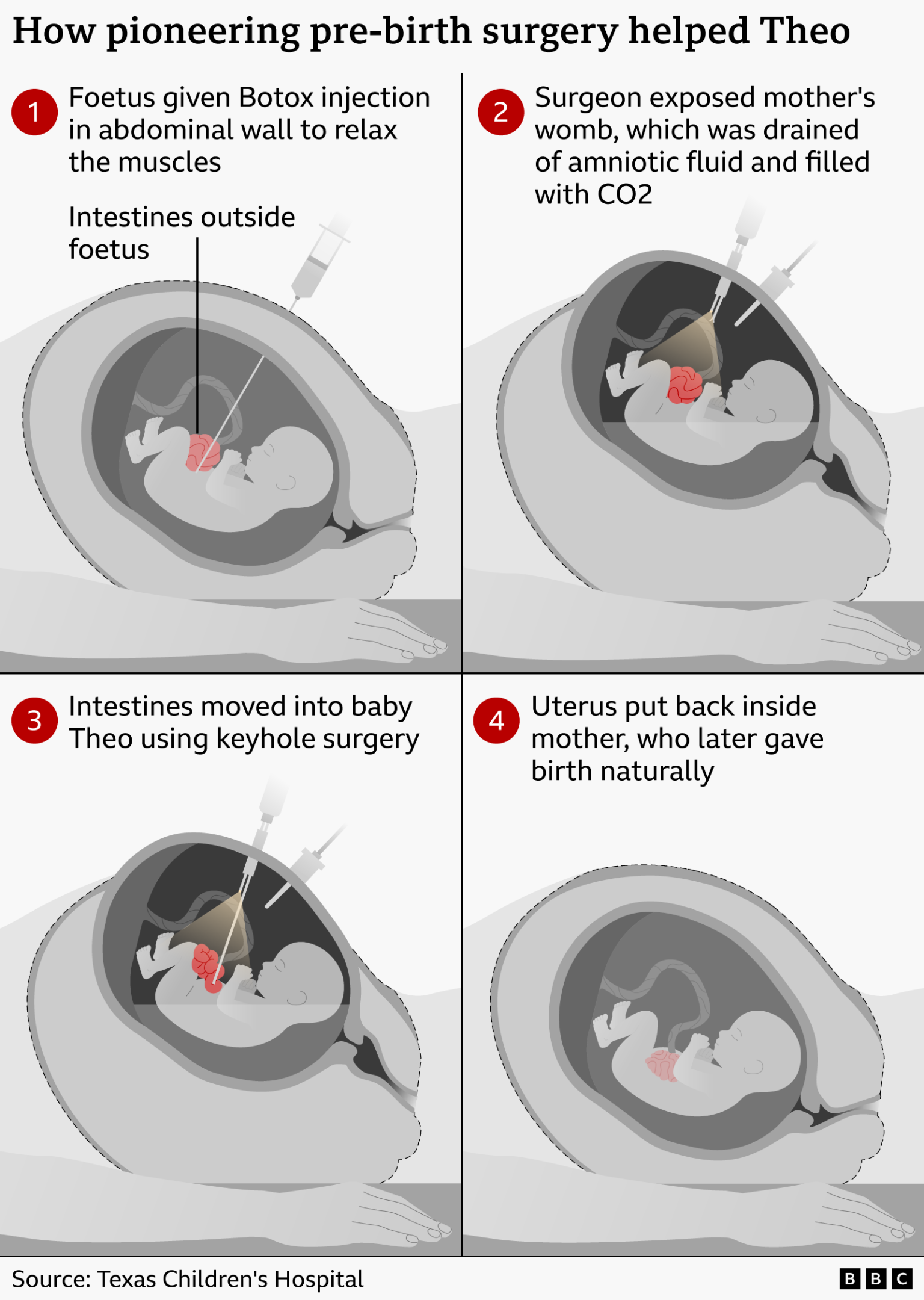 Infographic showing a four-step prenatal surgery. The foetus is given a Botox injection in the abdominal wall to relax the muscles, surgeons temporarily open the womb and use keyhole surgery to move a foetus’s intestines back inside the body before returning the uterus, allowing the pregnancy to continue until the healthy baby is born naturally.