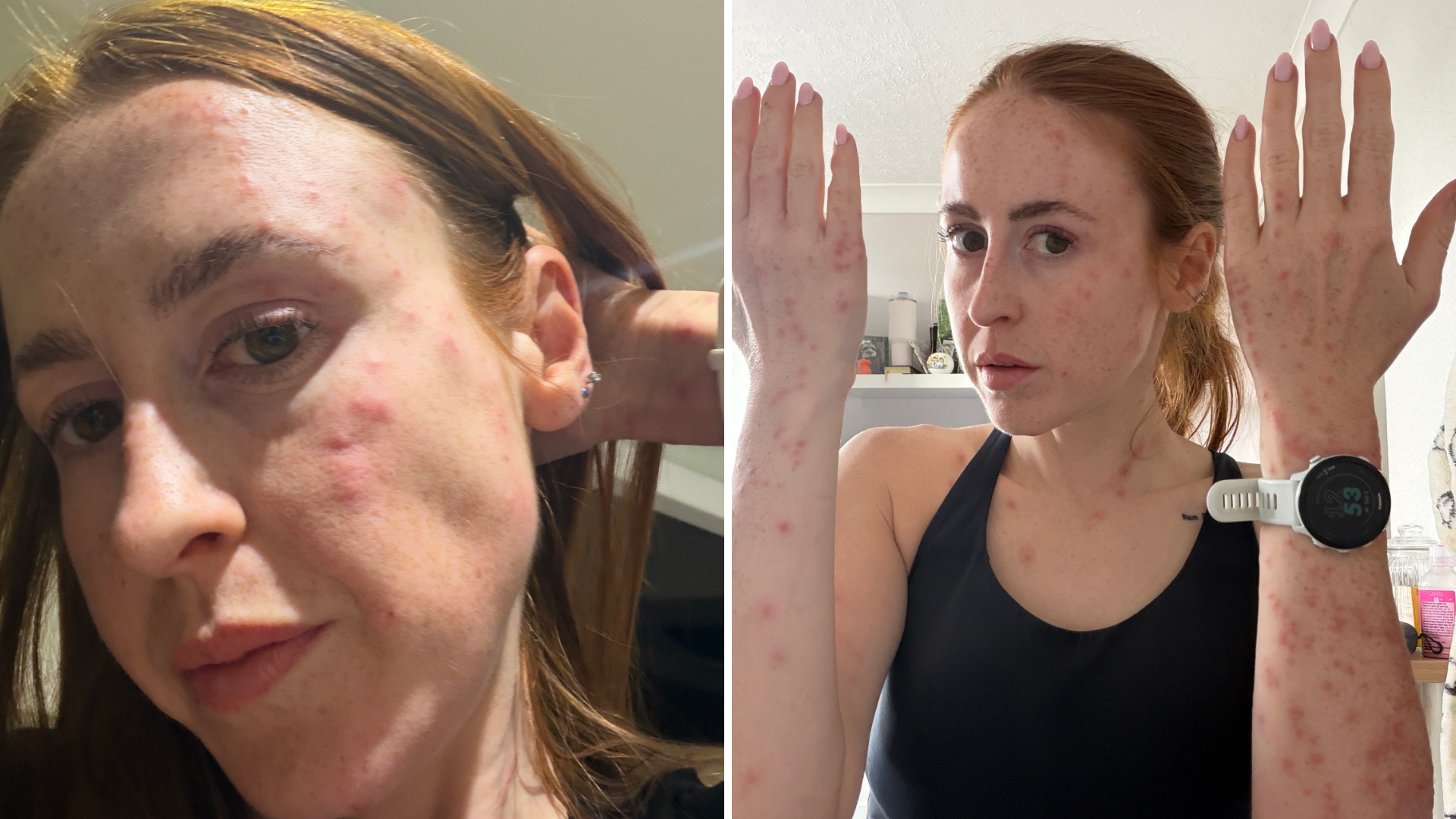 A composite of two pictures of Hannah Stephenson. On the left is a close-up picture of her face, which has a series of red raised lumps on her forehead, cheek and jaw. On the right is Hannah standing with both arms bent at the elbows and facing upwards towards the camera. She is wearing a black top and has a sports watch on her wrist. Her hair is tied back, and there are bite marks across both arms, her chest and face.