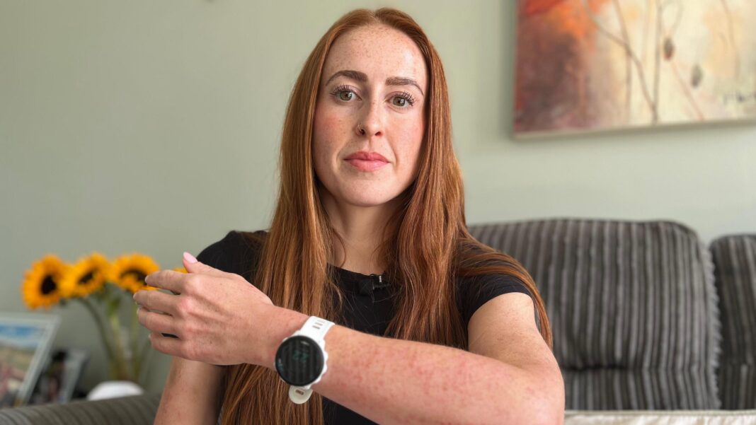 Woman attacked by bed bugs during Travelodge stay Woman attacked by bed bugs during Travelodge stay