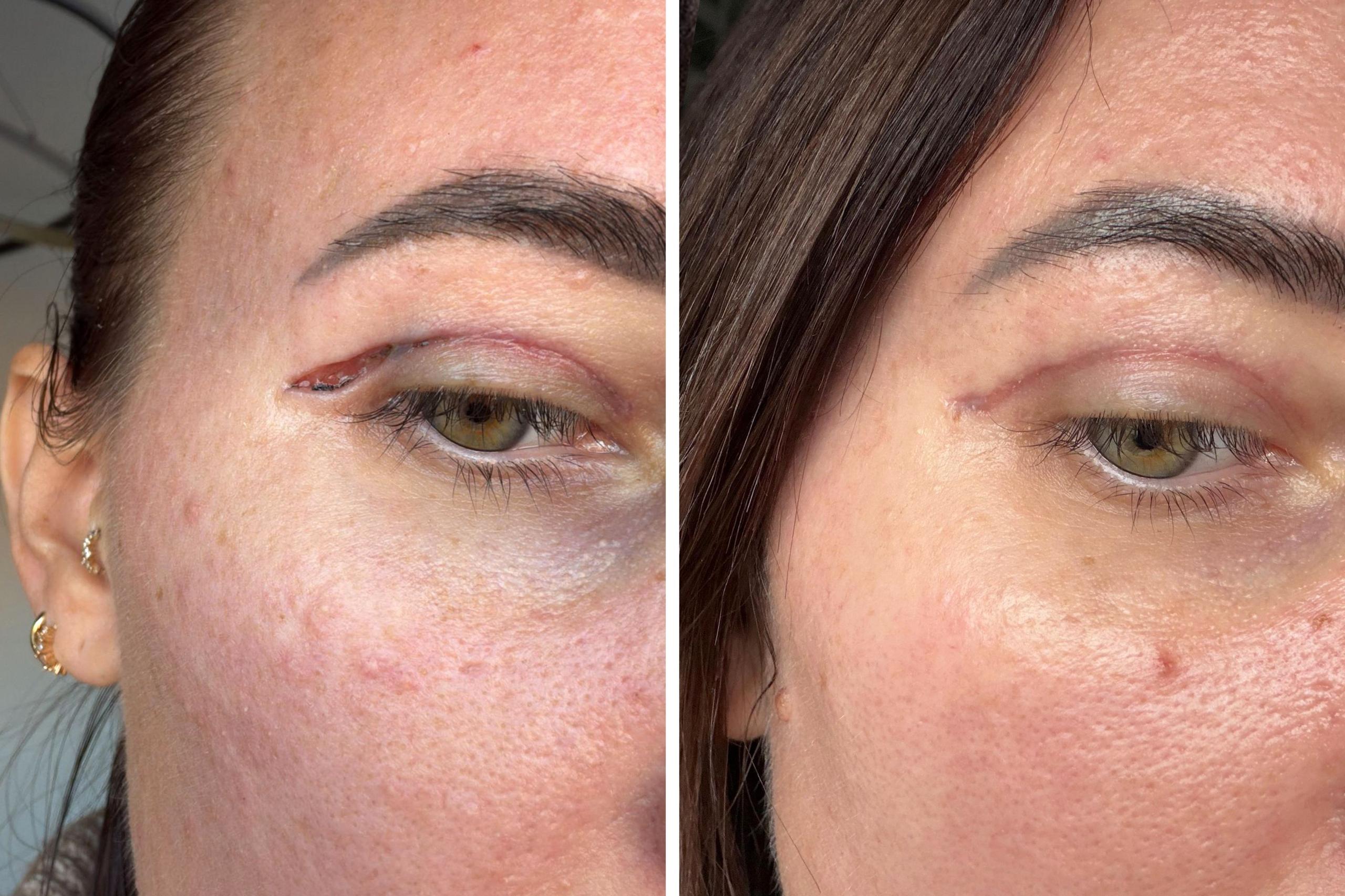 A side‑by‑side close‑up of the same person’s left eye area, showing a healing outer‑corner eyelid incision on the left with redness and slight swelling, and a smoother, less visible scar after healing on the right.