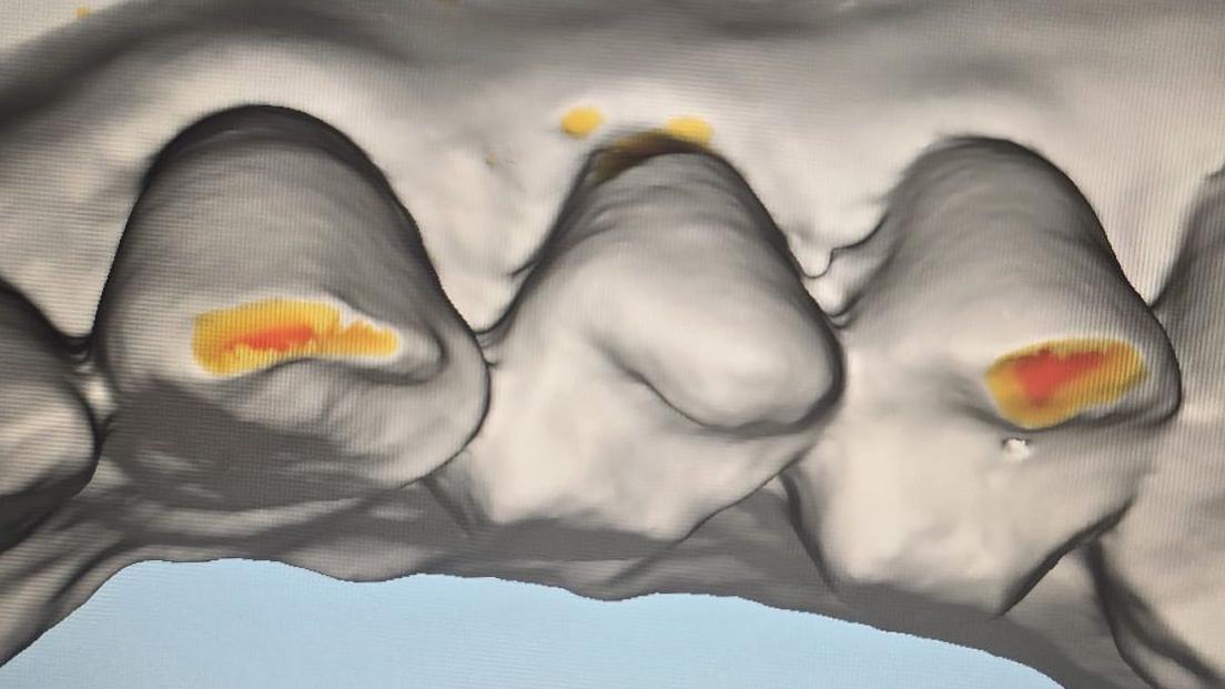 Scan of teeth showing areas worn down from grinding.