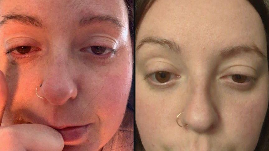 Lauren looks at the camera through bleary eyes. She said the affected eye droops, goes quite puffy and sometimes it goes watery and red like it does in the pic, slight face flushing, as is shown in this photo.