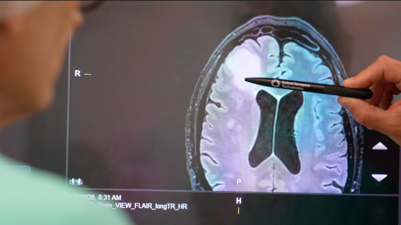 A scan of a brain shows a patch of light, about one twelfth the size of the brain. A hand holding a pen is pointing to the patch