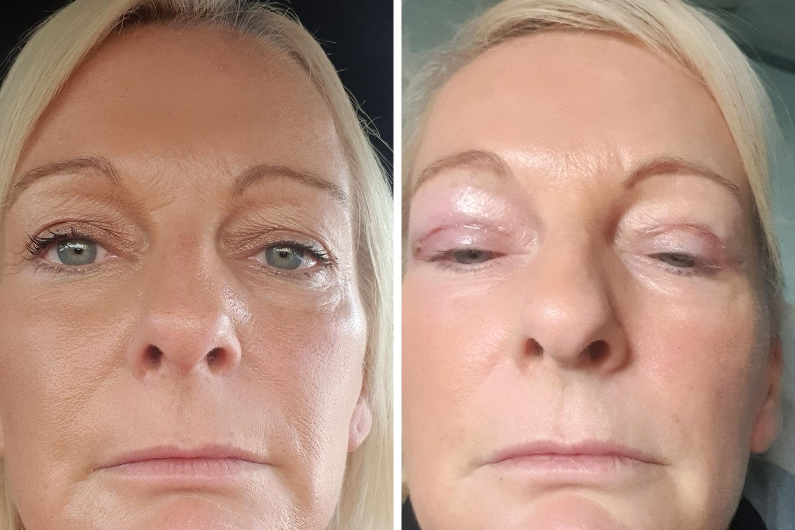 Side‑by‑side images showing Caryn before the eyelid surgery and afterwards. Second image shows a red scar on the upper eyelid as the area begins to heal.