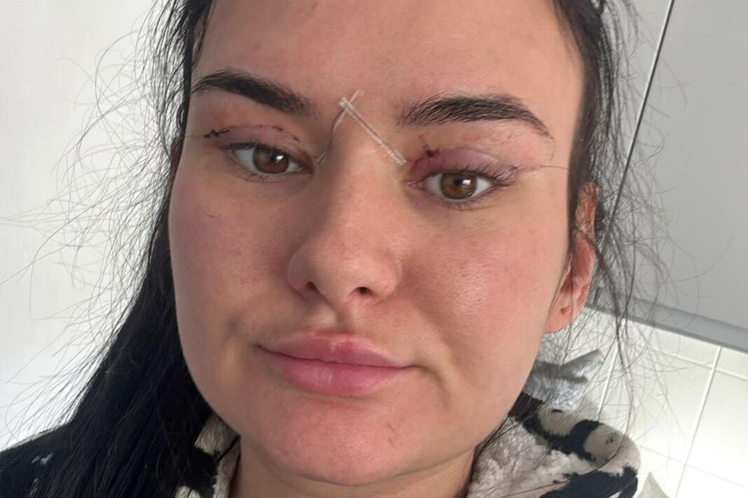 Open wounds and eyes that can’t close – women warn about cheap bleph eyelid surgery A close-up of a Nikita's face showing post-surgical healing, with adhesive strips and sutures around both eyes and across the bridge of the nose. The eyelids appear swollen and red, indicating recent medical treatment.