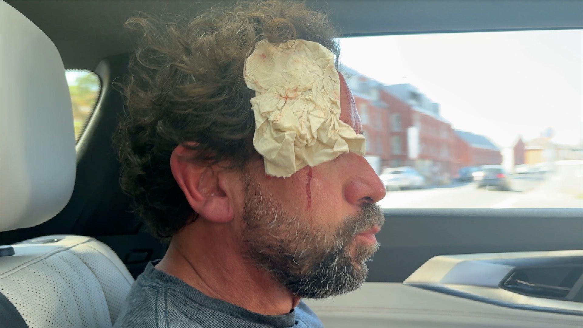 Pol sits in a car with a bloody tissue covering his eye.