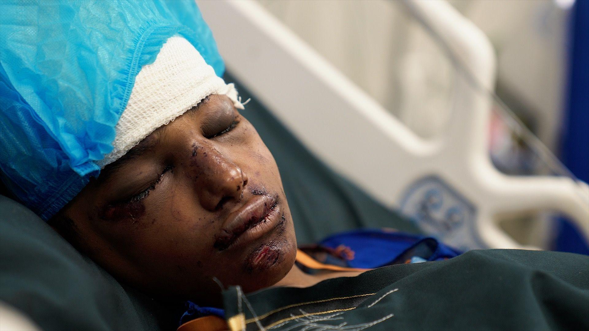 A girl lying on a hospital bed after an operation to remove shrapnel from her head