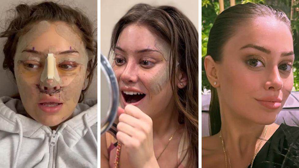 A composite image showing Emily, a woman with long brown hair, in recovery, smiling into a mirror with sticking plasters still on her face and after fully recovering with no bandages on