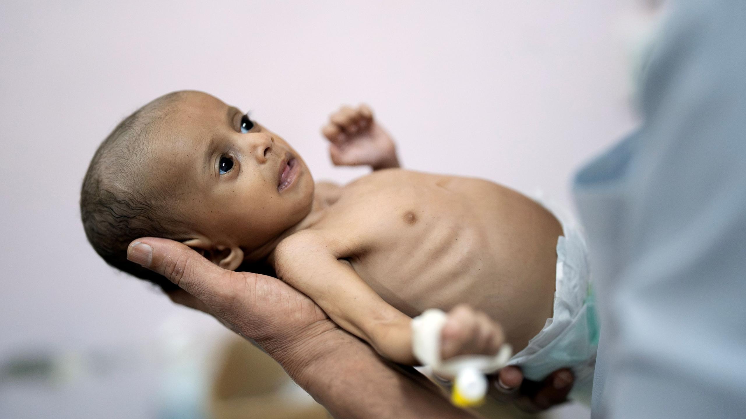 Malnourished girl Raghad Hassan at a hospital in Aden, Yemen