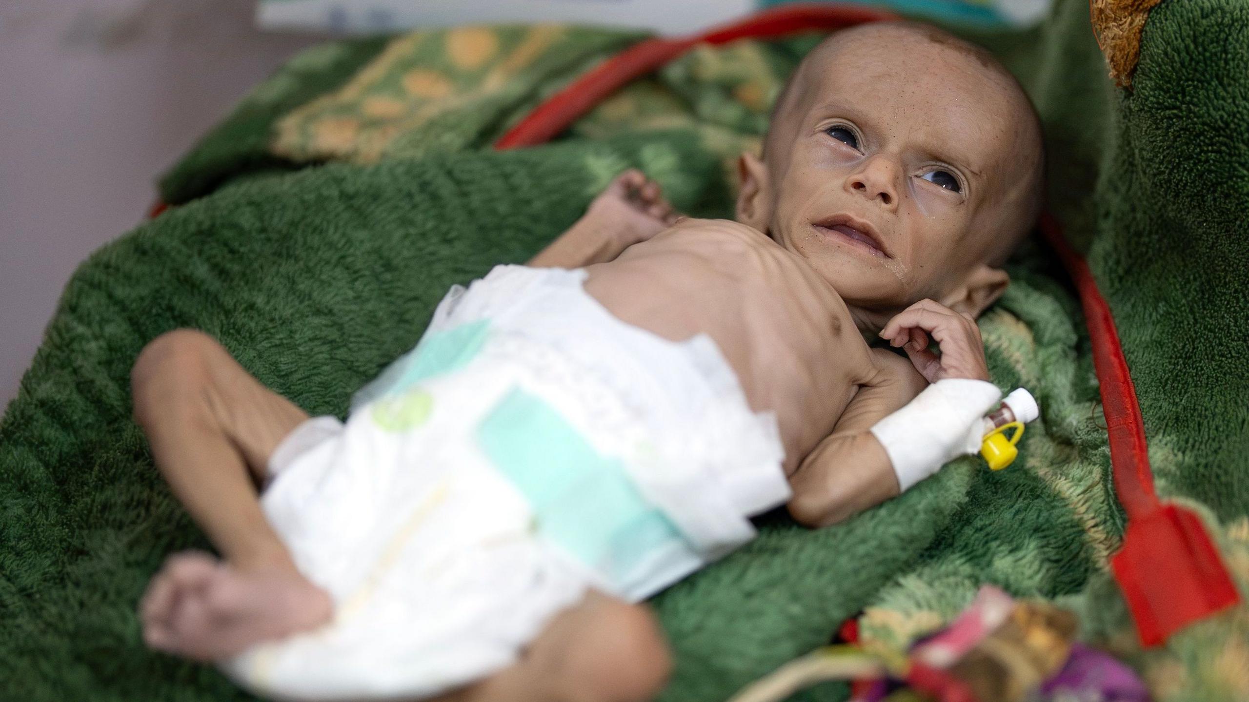 Malnourished boy Raad Hassan at a hospital in Aden, Yemen